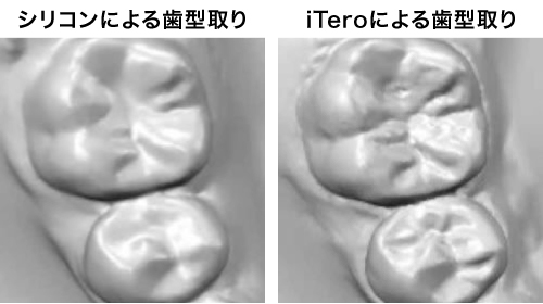 iTero Elementによる歯形の方が細かい溝を再現できています