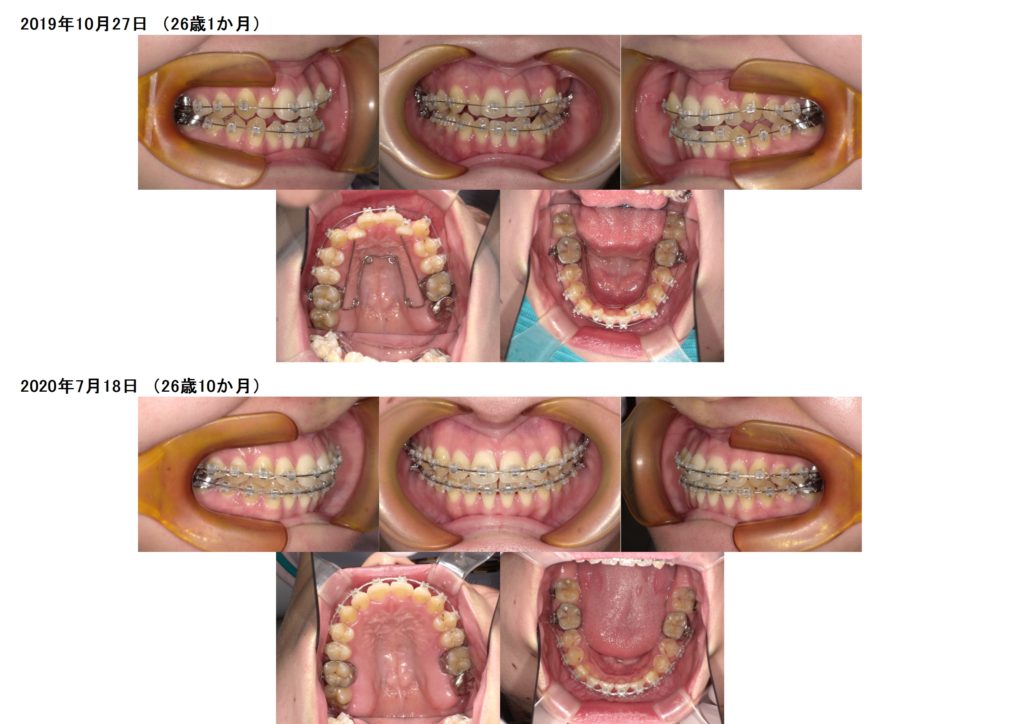 痛みの少ないブラケット セルフライゲーションブラケット｜名古屋西