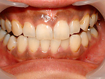 歯肉ブリーチング