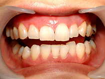 歯肉ブリーチング