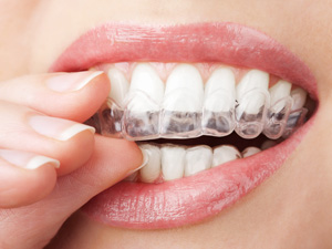 クリアアライナー
