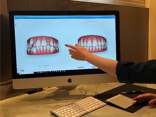 歯形をデジタルデータ化