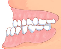 不正咬合
