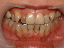 ホワイトニング