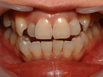 ホワイトニング