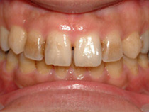 ホワイトニング