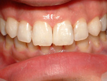 ホワイトニング