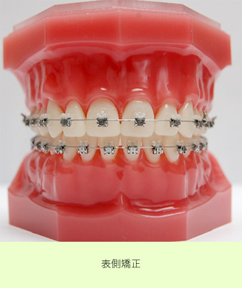 表側矯正