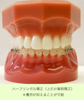 ハーフリンガル矯正