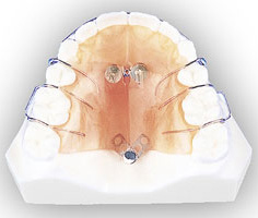 子どもの矯正治療