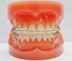 大人の矯正治療